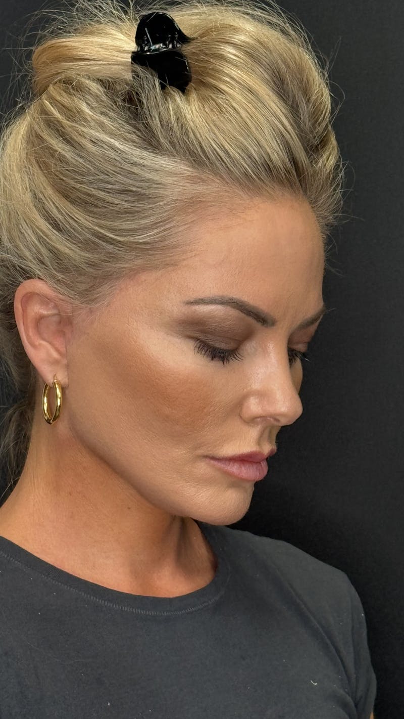 Deep Plane Facelift 40s Before & After Gallery - Patient 419923 - Image 8