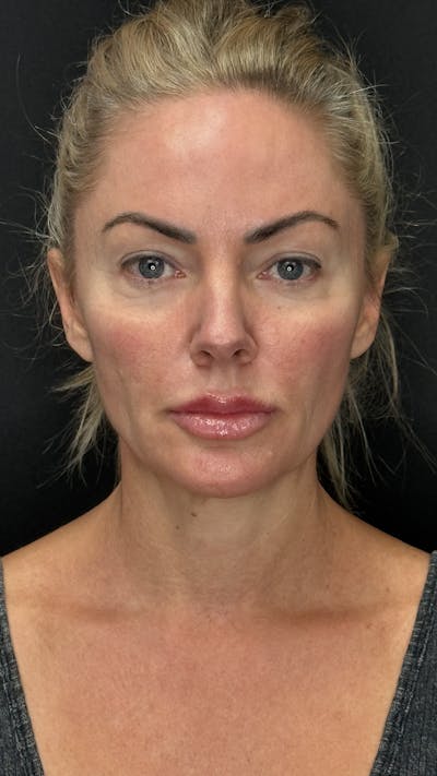 Deep Plane Facelift 40s Before & After Gallery - Patient 419923 - Image 1