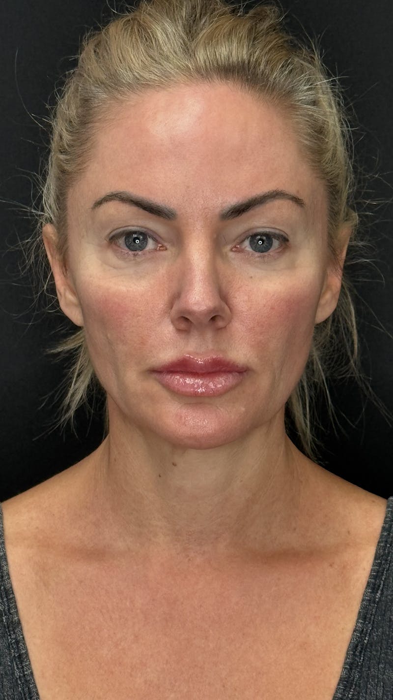 Deep Plane Facelift 40s Before & After Gallery - Patient 419923 - Image 1