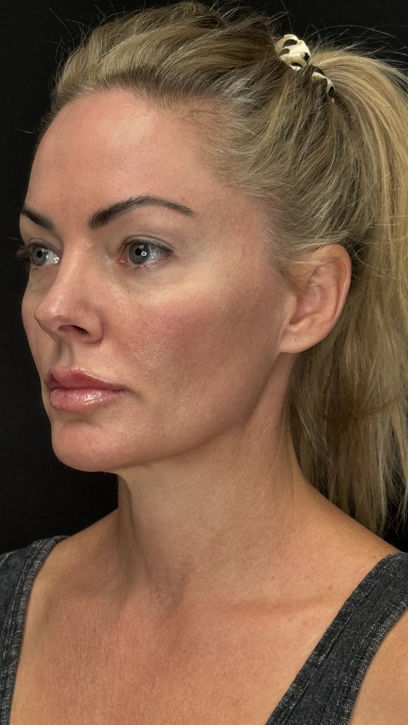 Deep Plane Facelift 40s Before & After Gallery - Patient 419923 - Image 3