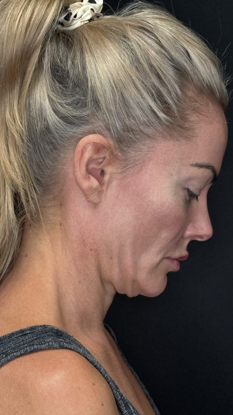 Deep Plane Facelift 40s Before & After Gallery - Patient 419923 - Image 9