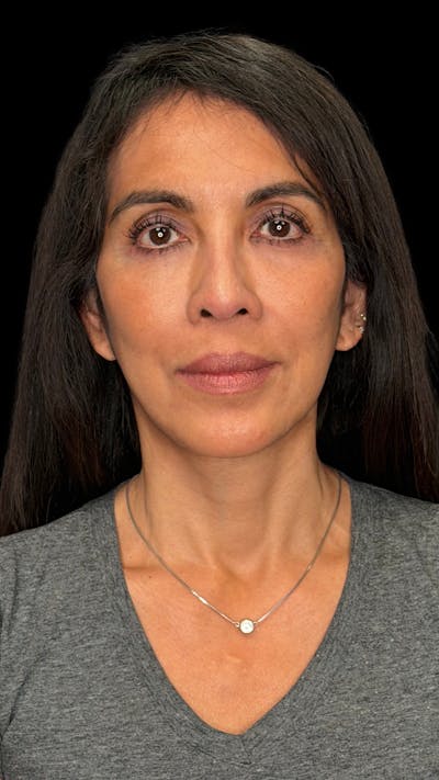 Deep Plane Facelift 50s Before & After Gallery - Patient 380369 - Image 2