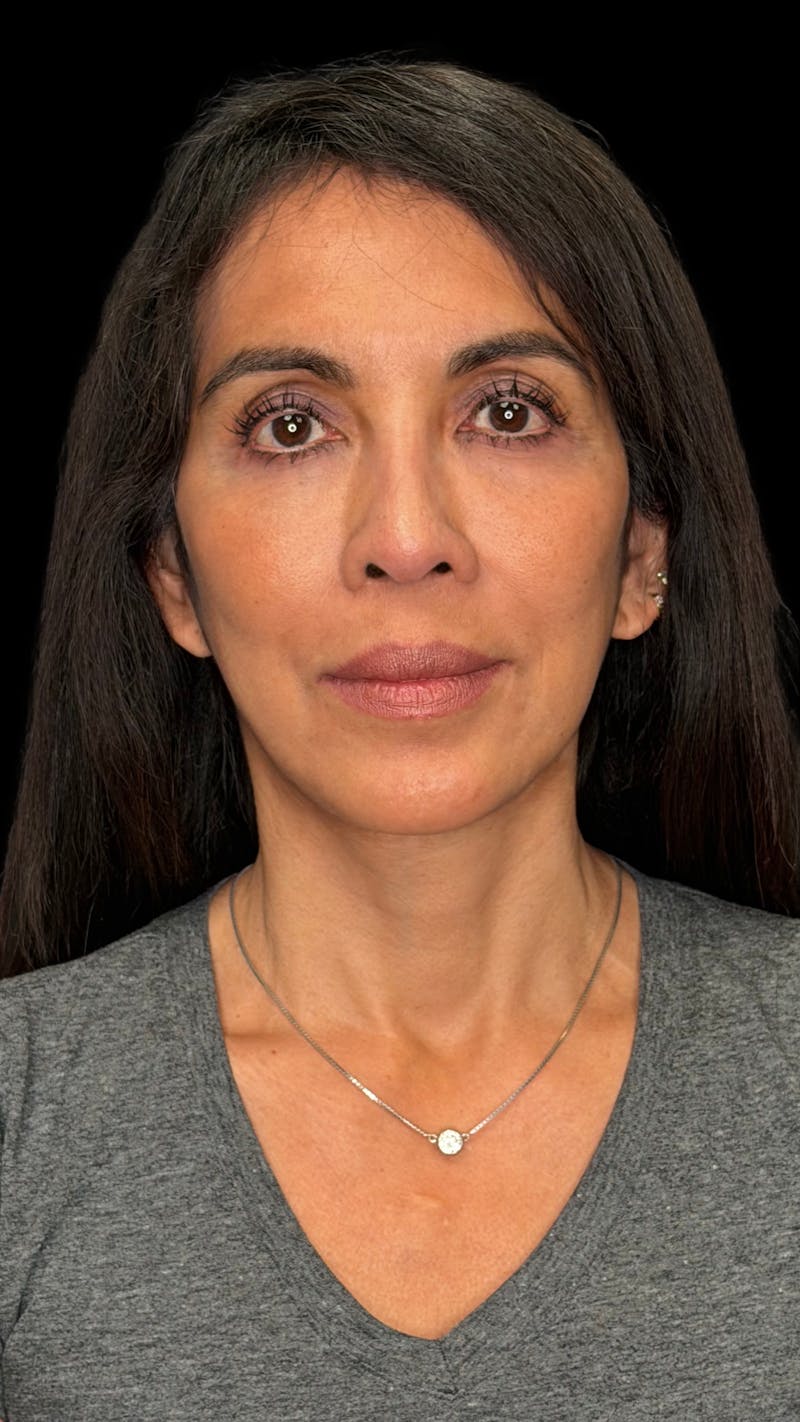 Deep Plane Facelift 50s Before & After Gallery - Patient 380369 - Image 2