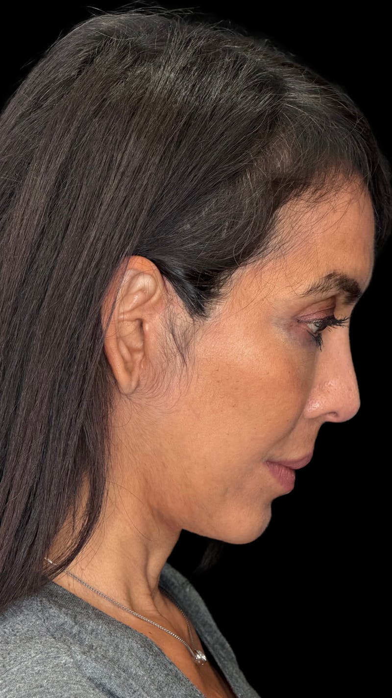 Deep Plane Facelift 50s Before & After Gallery - Patient 380369 - Image 12
