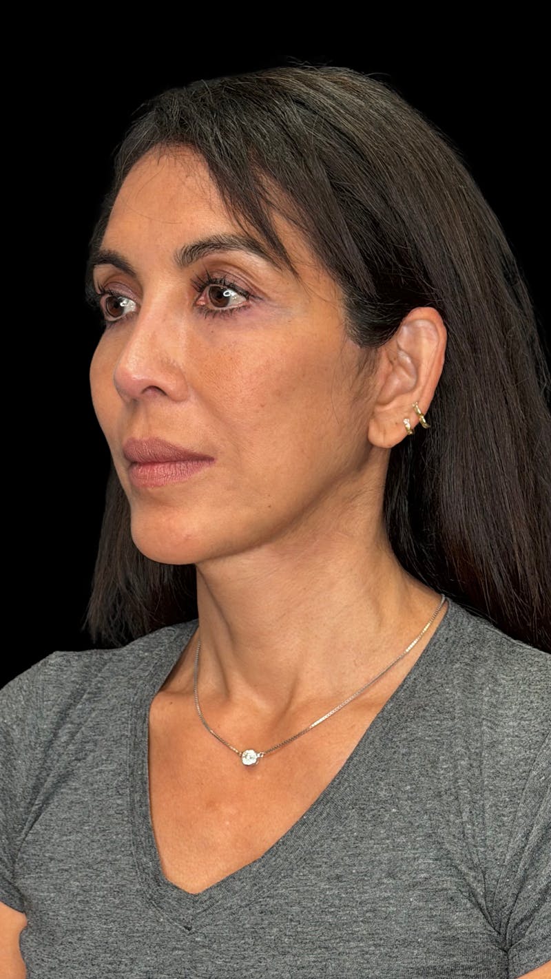 Deep Plane Facelift 50s Before & After Gallery - Patient 380369 - Image 6