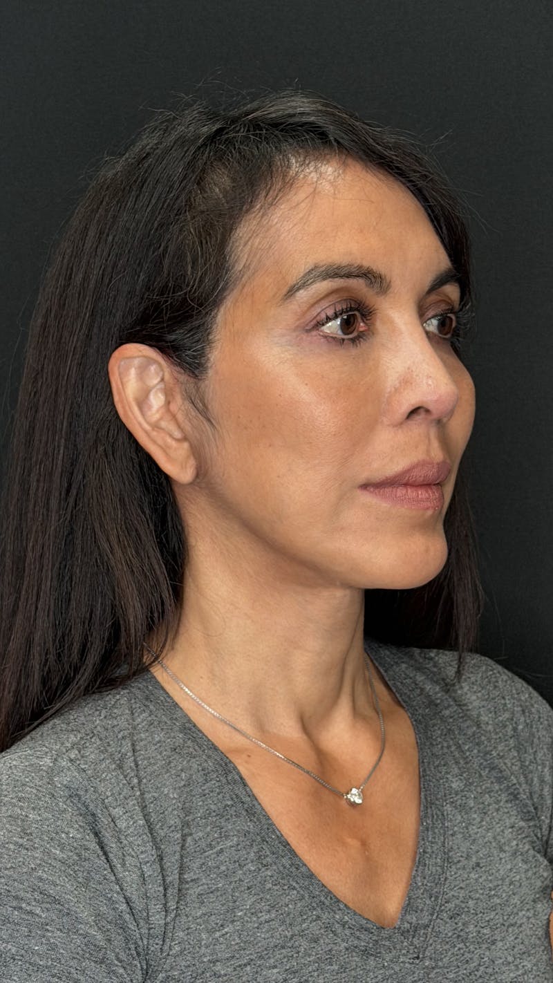 Deep Plane Facelift 50s Before & After Gallery - Patient 380369 - Image 4