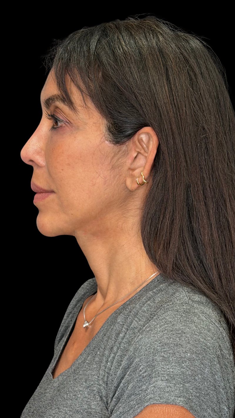 Deep Plane Facelift 50s Before & After Gallery - Patient 380369 - Image 8