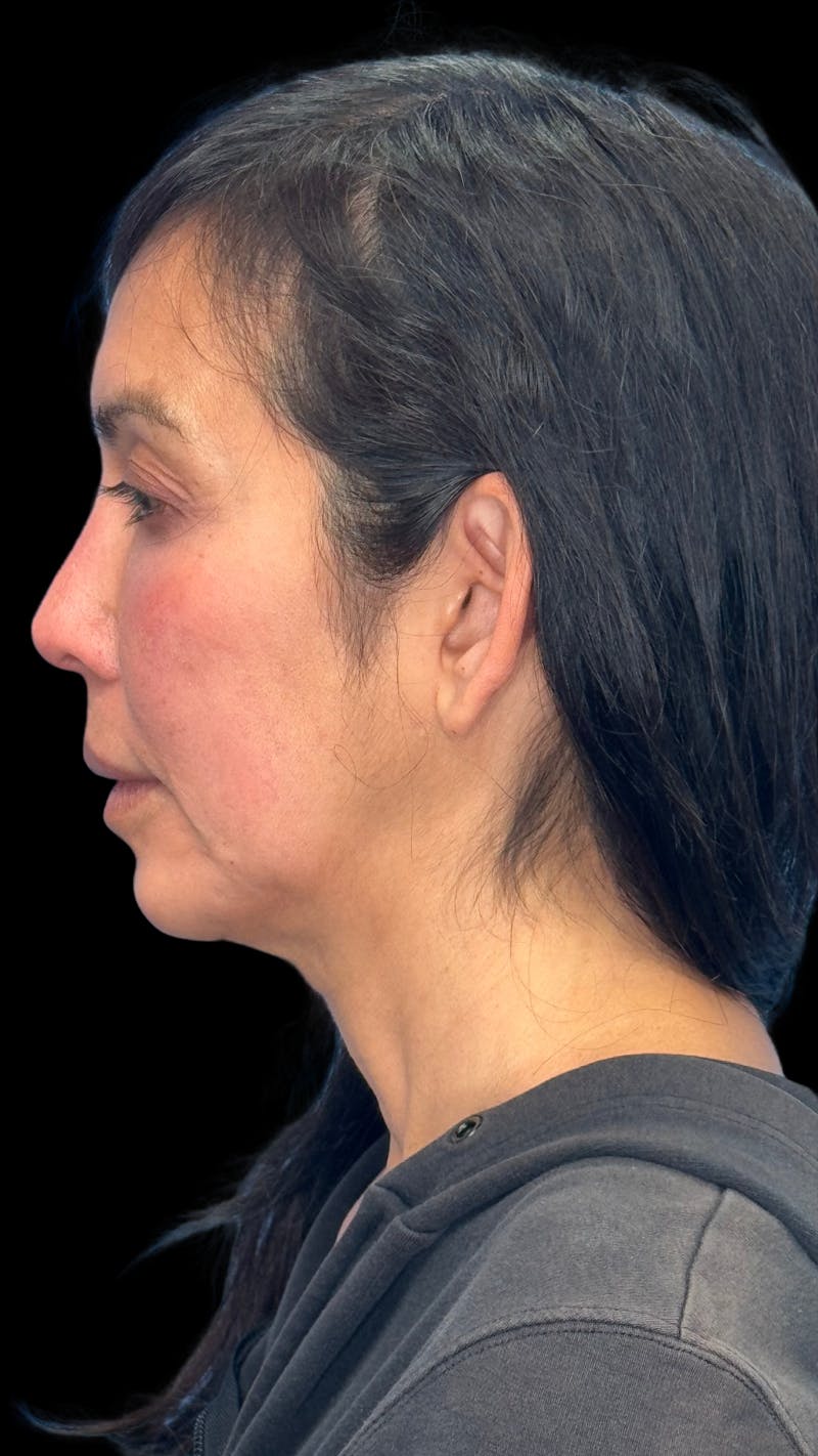Deep Plane Facelift 50s Before & After Gallery - Patient 380369 - Image 7