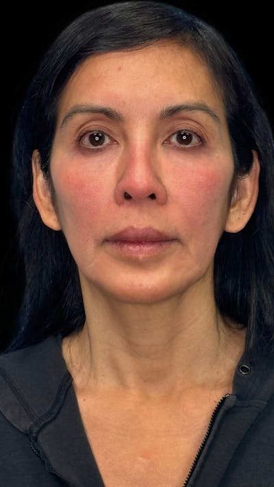 Deep Plane Facelift 50s Before & After Gallery - Patient 380369 - Image 1