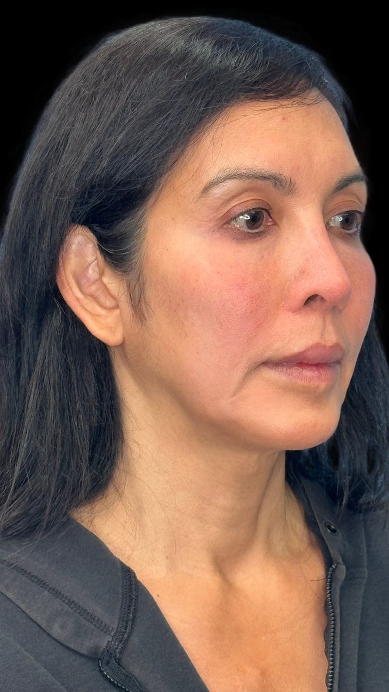 Deep Plane Facelift 50s Before & After Gallery - Patient 380369 - Image 3