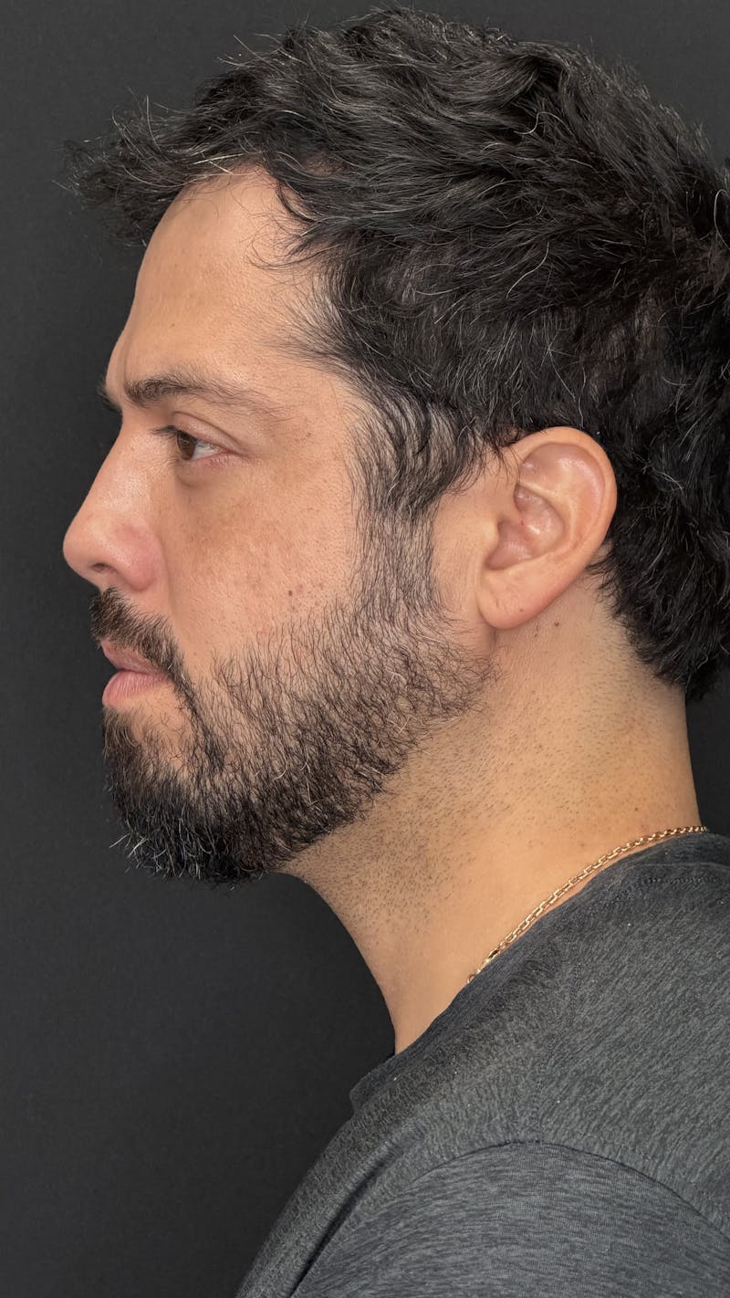 Lower Eye Rejuvenation Before & After Gallery - Patient 201920 - Image 10