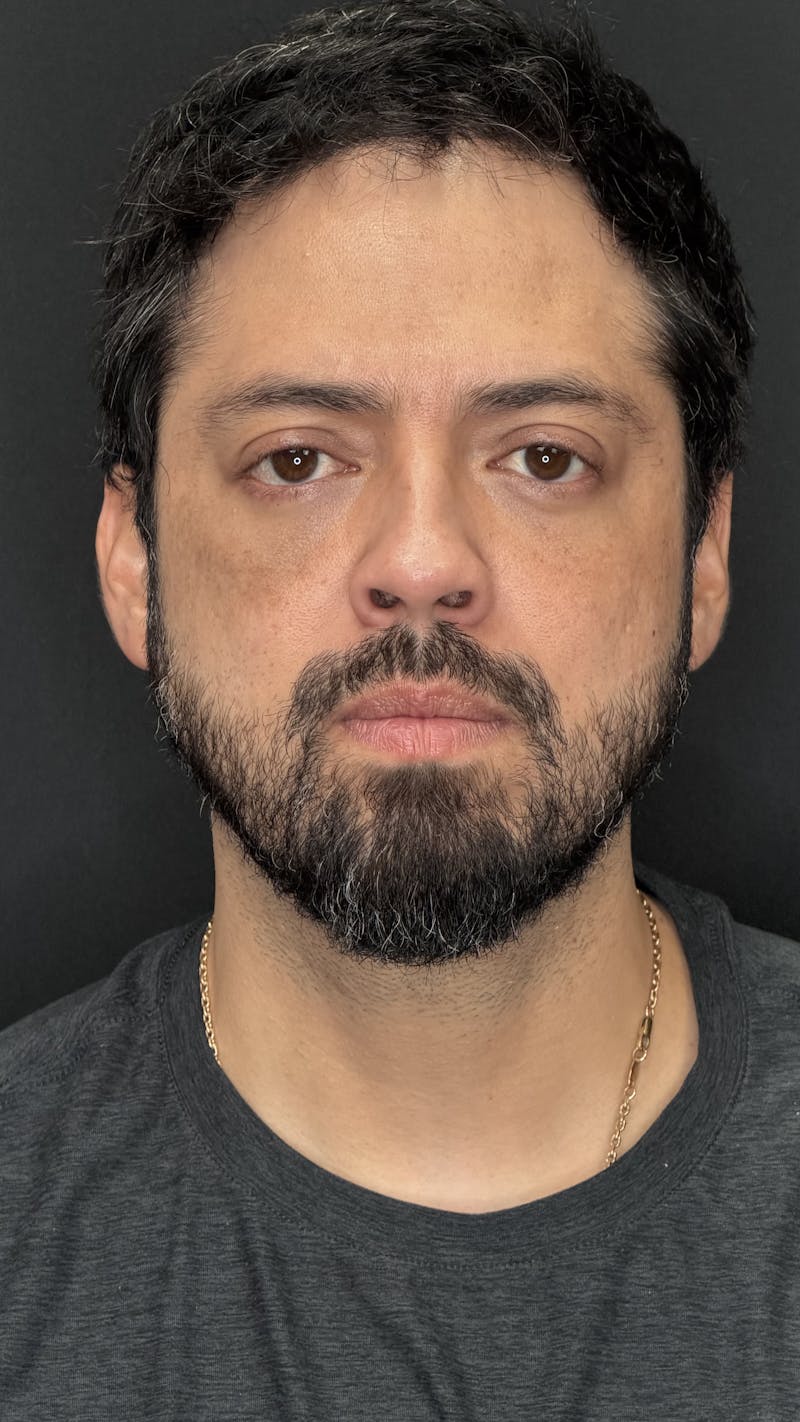 Lower Eye Rejuvenation Before & After Gallery - Patient 201920 - Image 2