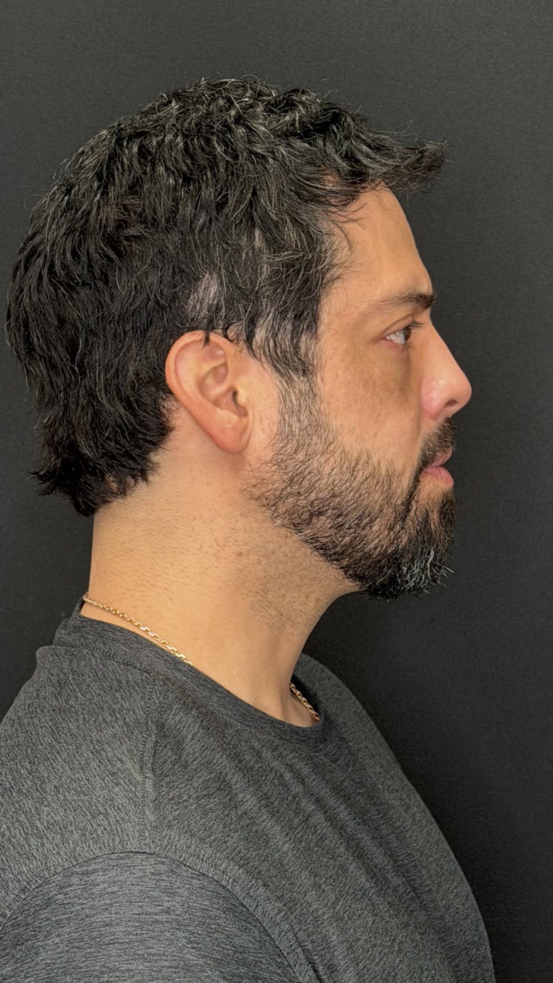 Lower Eye Rejuvenation Before & After Gallery - Patient 201920 - Image 6