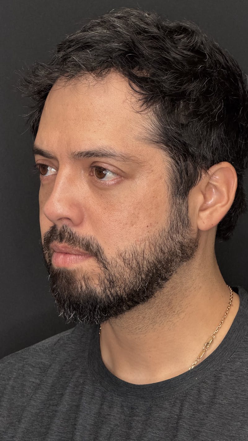 Lower Eye Rejuvenation Before & After Gallery - Patient 201920 - Image 8