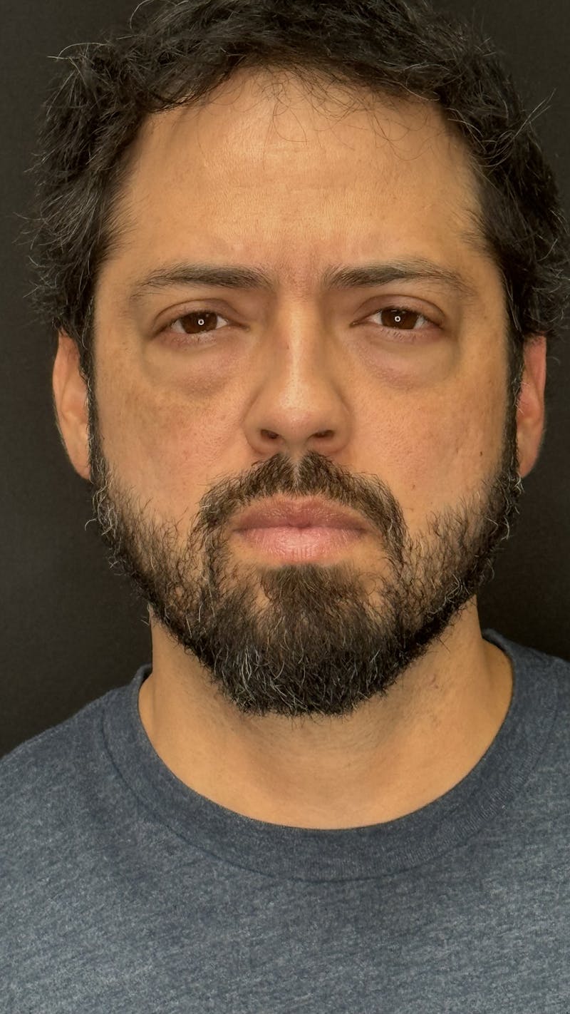 Lower Eye Rejuvenation Before & After Gallery - Patient 201920 - Image 1