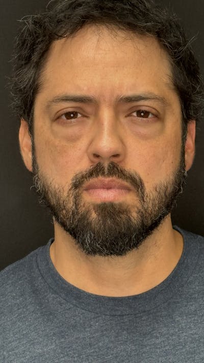 Lower Eye Rejuvenation Before & After Gallery - Patient 201920 - Image 1