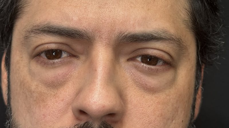Lower Eye Rejuvenation Before & After Gallery - Patient 201920 - Image 11