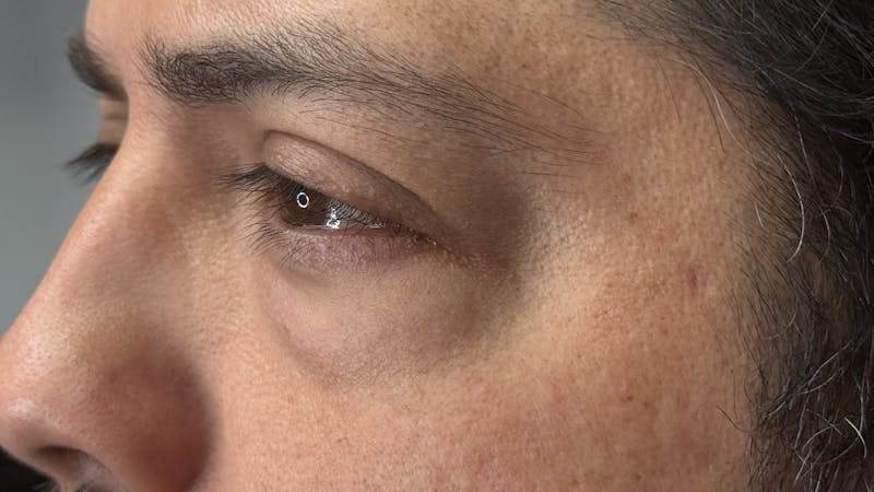 Lower Eye Rejuvenation Before & After Gallery - Patient 201920 - Image 13