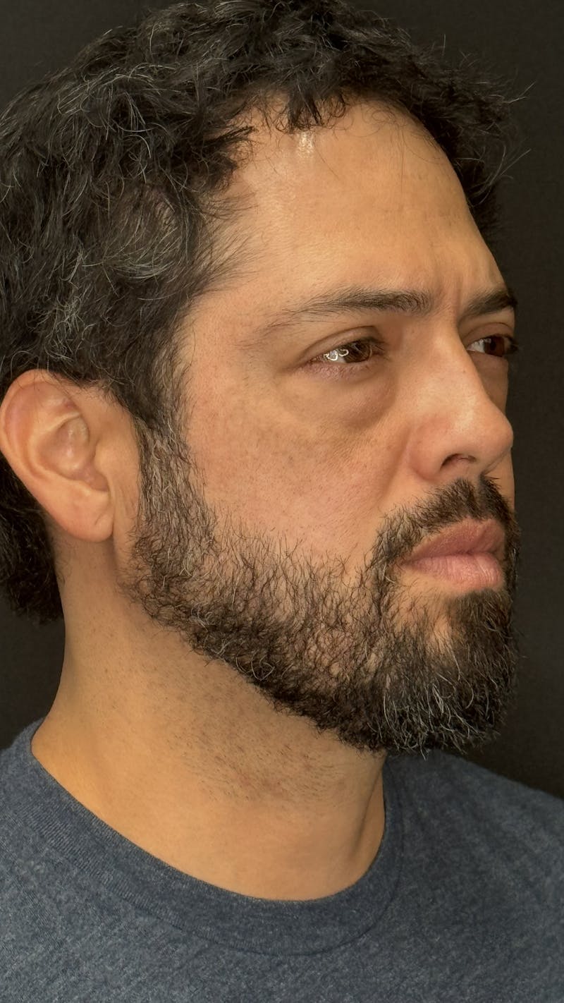 Lower Eye Rejuvenation Before & After Gallery - Patient 201920 - Image 3