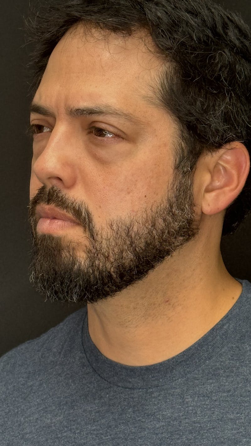 Lower Eye Rejuvenation Before & After Gallery - Patient 201920 - Image 7