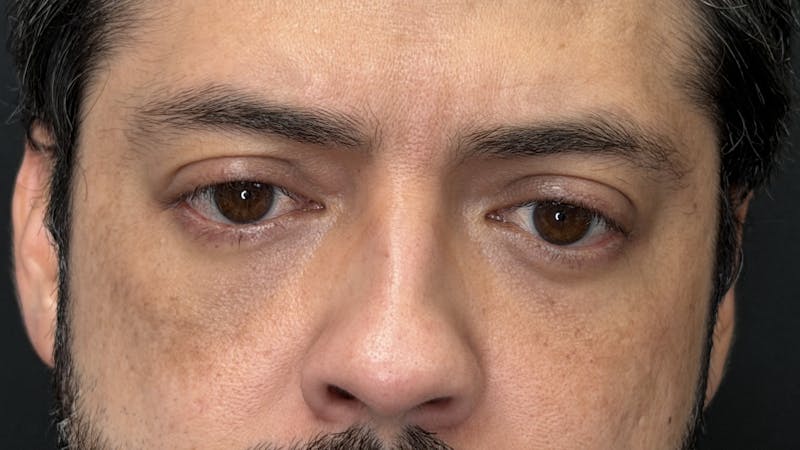 Lower Eye Rejuvenation Before & After Gallery - Patient 201920 - Image 12