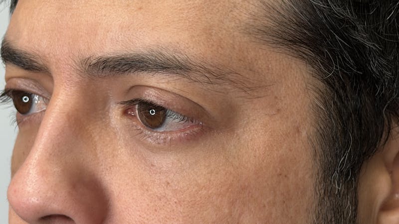 Lower Eye Rejuvenation Before & After Gallery - Patient 201920 - Image 14