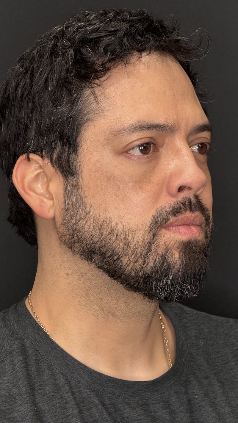 Lower Eye Rejuvenation Before & After Gallery - Patient 201920 - Image 4