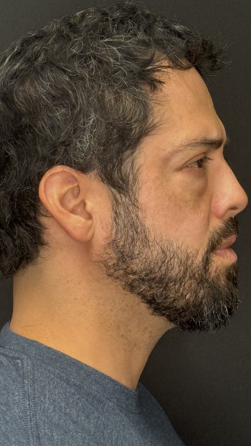 Lower Eye Rejuvenation Before & After Gallery - Patient 201920 - Image 5