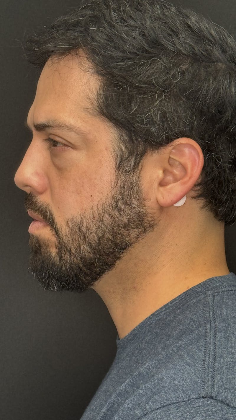 Lower Eye Rejuvenation Before & After Gallery - Patient 201920 - Image 9