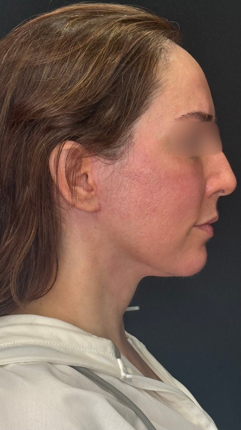 Deep Plane Facelift 40s Before & After Gallery - Patient 420969 - Image 10