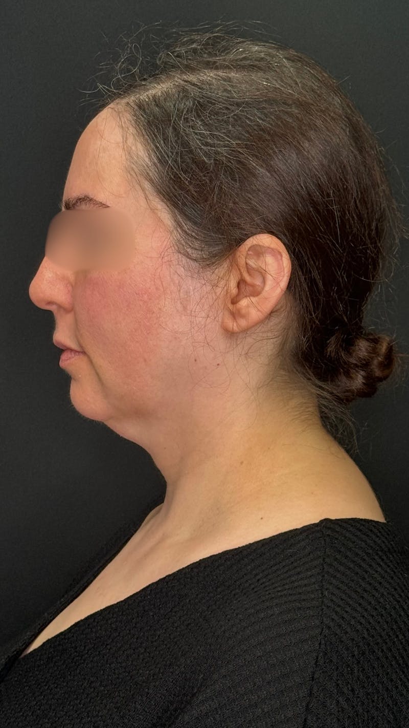 Deep Plane Facelift 40s Before & After Gallery - Patient 420969 - Image 5