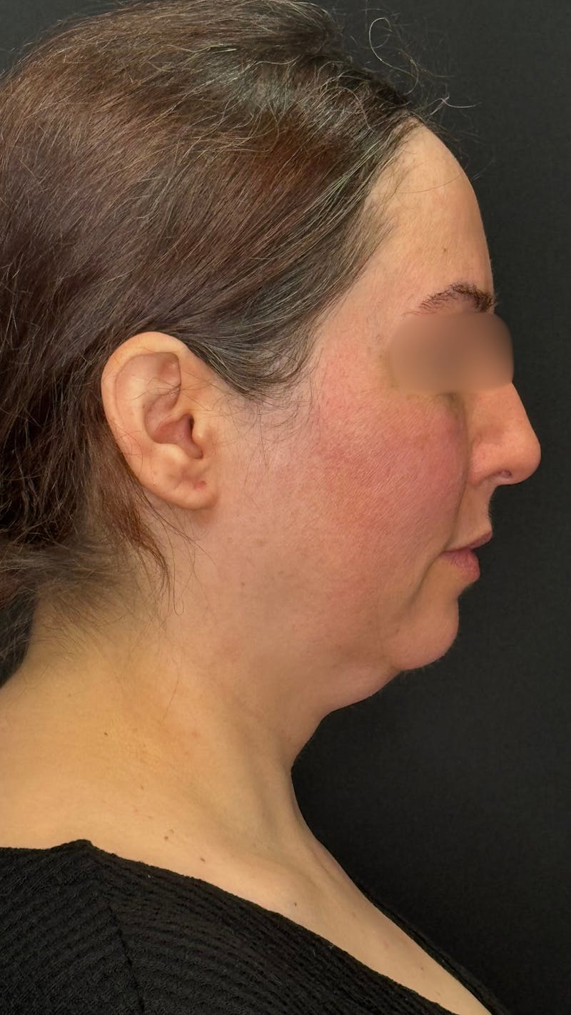 Deep Plane Facelift 40s Before & After Gallery - Patient 420969 - Image 9