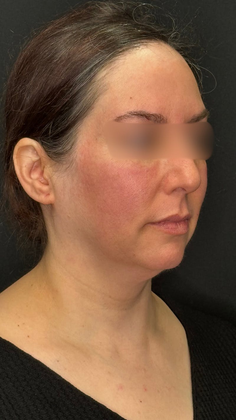 Deep Plane Facelift 40s Before & After Gallery - Patient 420969 - Image 11
