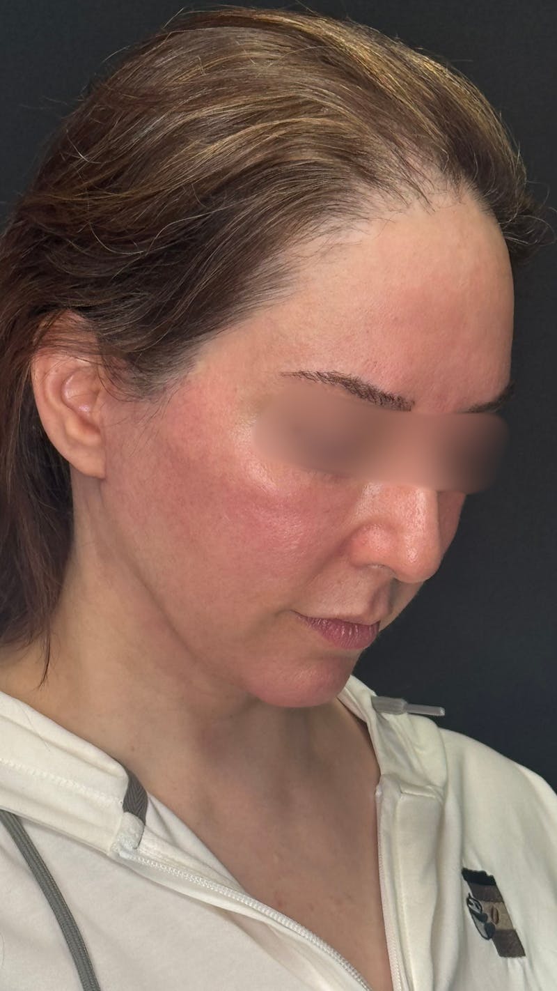 Deep Plane Facelift 40s Before & After Gallery - Patient 420969 - Image 8