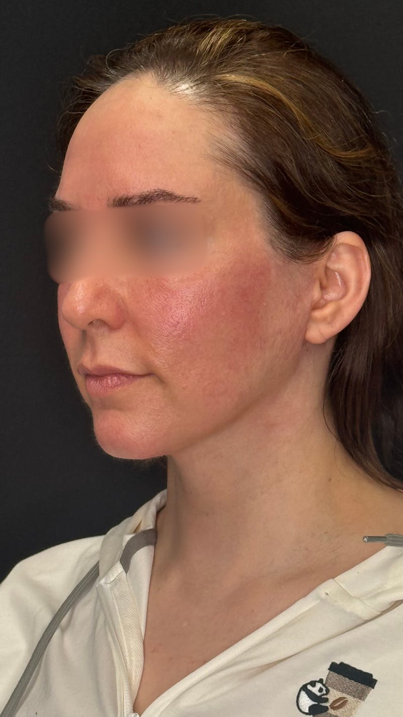 Deep Plane Facelift 40s Before & After Gallery - Patient 420969 - Image 4