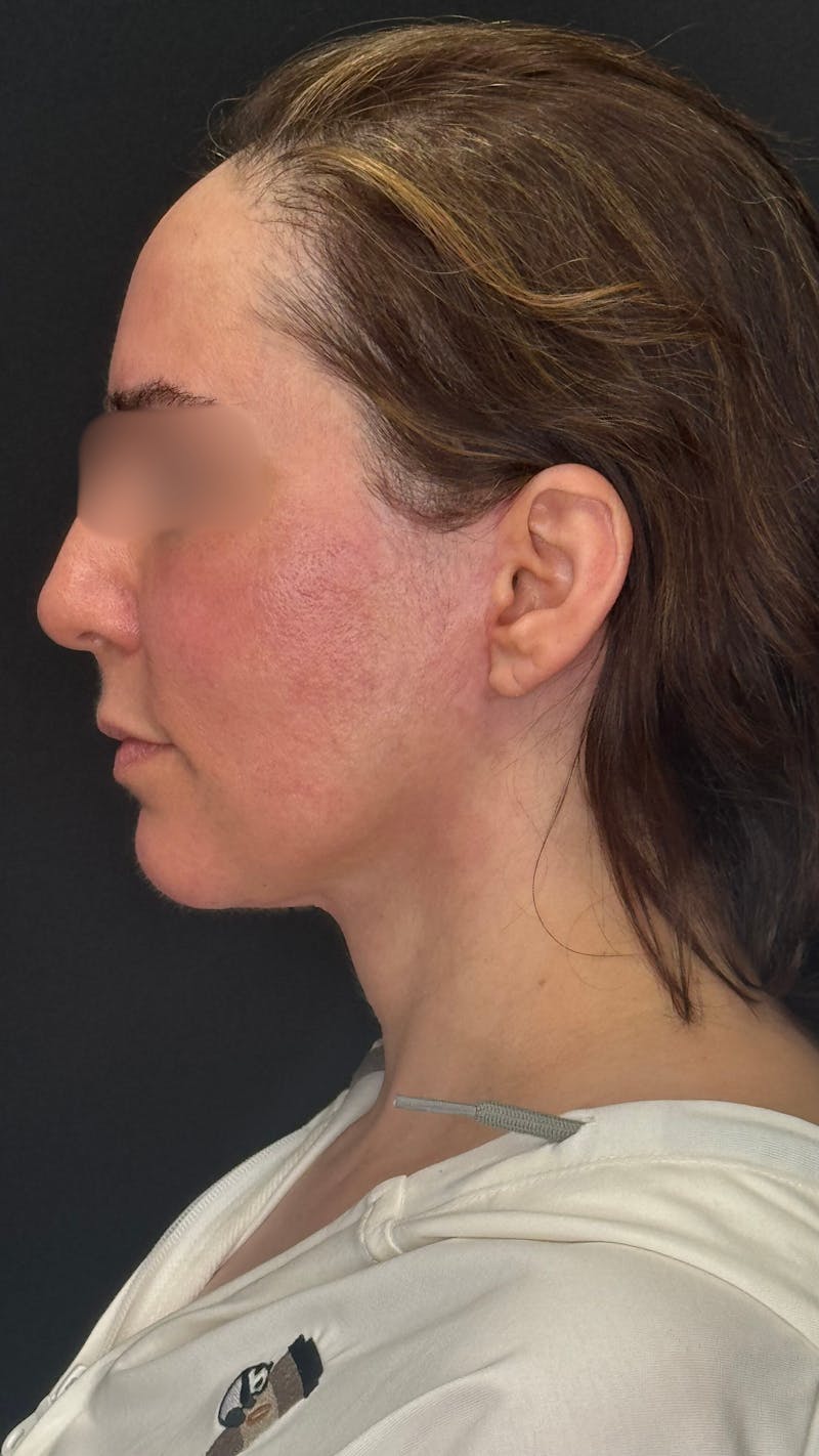 Deep Plane Facelift 40s Before & After Gallery - Patient 420969 - Image 6