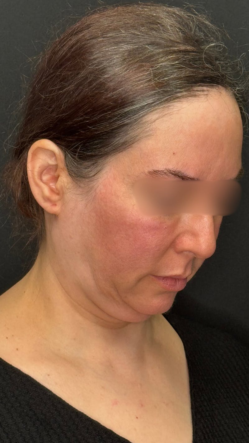 Deep Plane Facelift 40s Before & After Gallery - Patient 420969 - Image 7