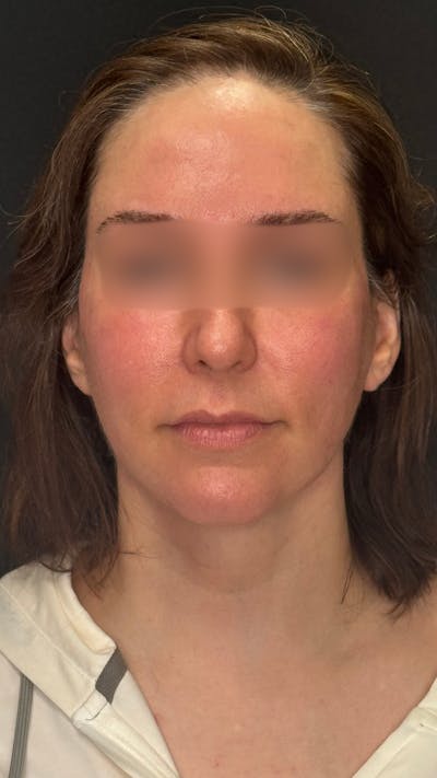 Deep Plane Facelift 40s Before & After Gallery - Patient 420969 - Image 2