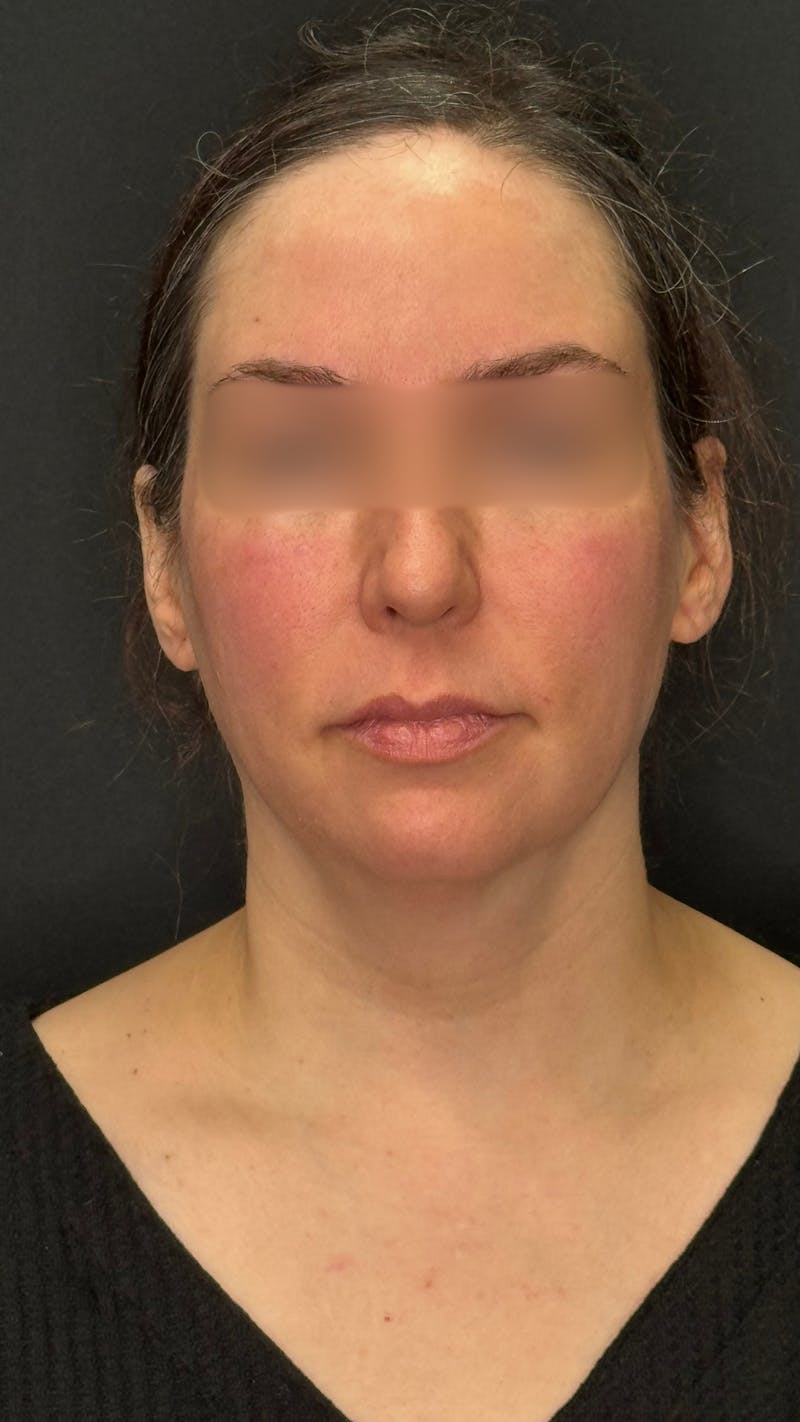 Deep Plane Facelift 40s Before & After Gallery - Patient 420969 - Image 1