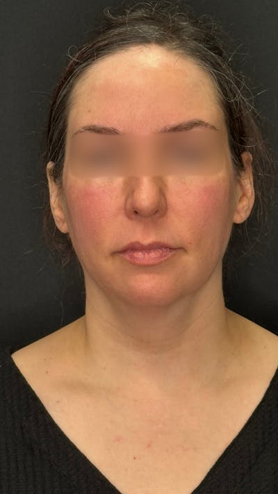 ContourLift Before & After Gallery - Patient 143994 - Image 1