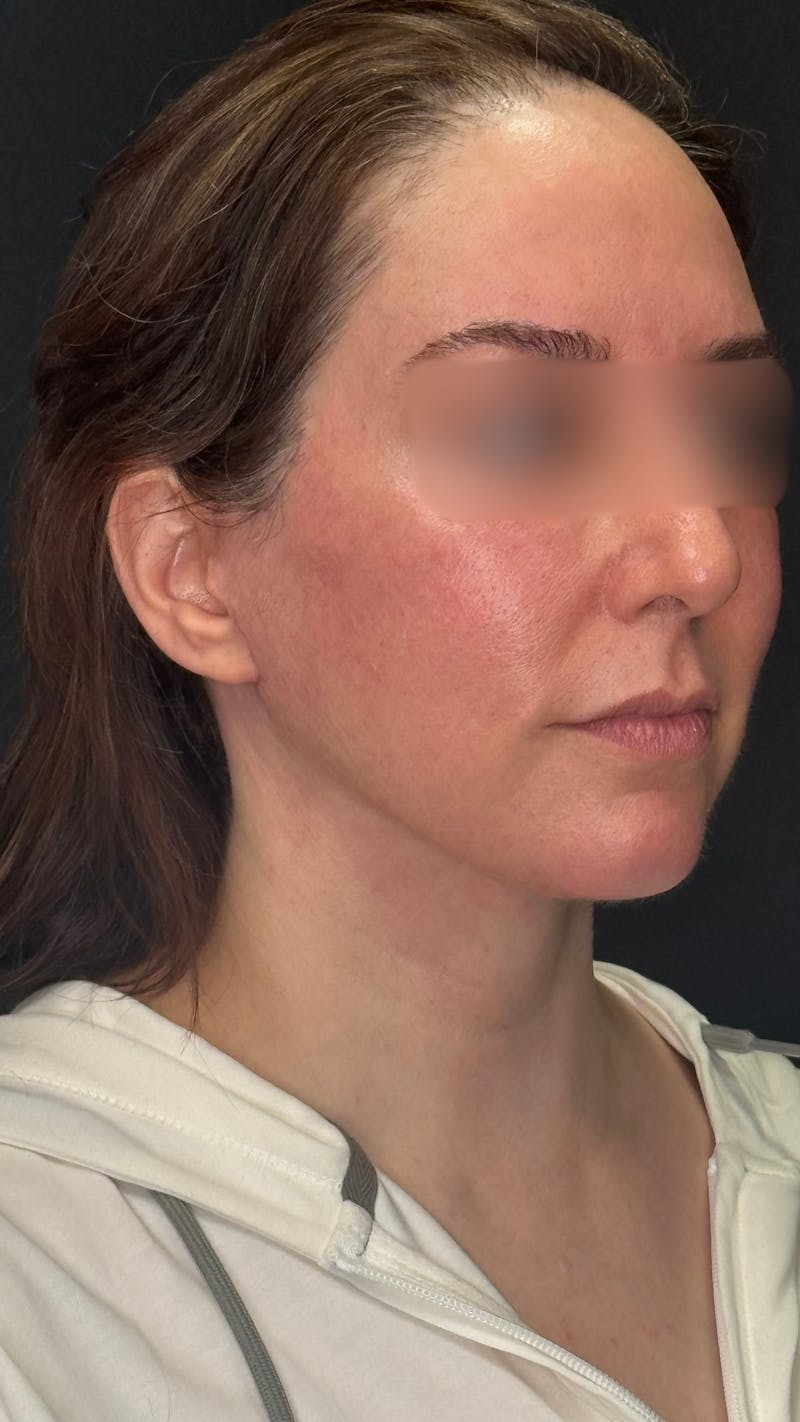Deep Plane Facelift 40s Before & After Gallery - Patient 420969 - Image 12