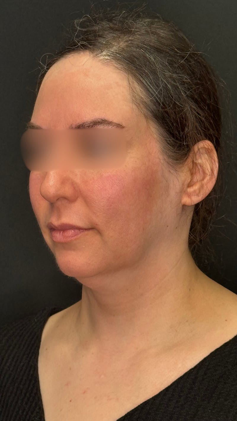 Deep Plane Facelift 40s Before & After Gallery - Patient 420969 - Image 3