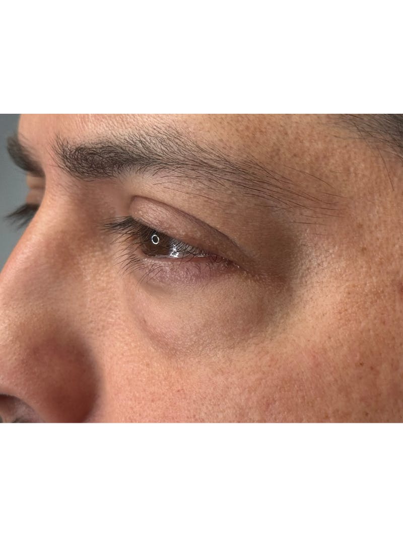 Lower Eye Rejuvenation Before & After Gallery - Patient 201920 - Image 13