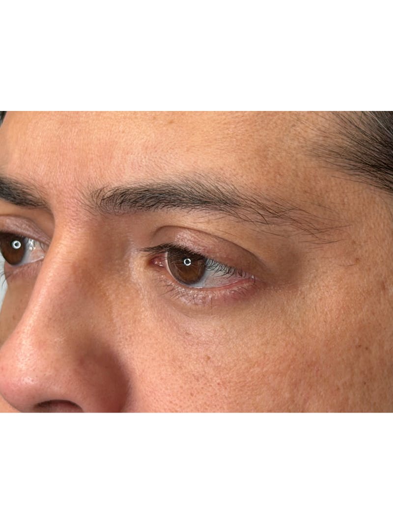 Lower Eye Rejuvenation Before & After Gallery - Patient 201920 - Image 14