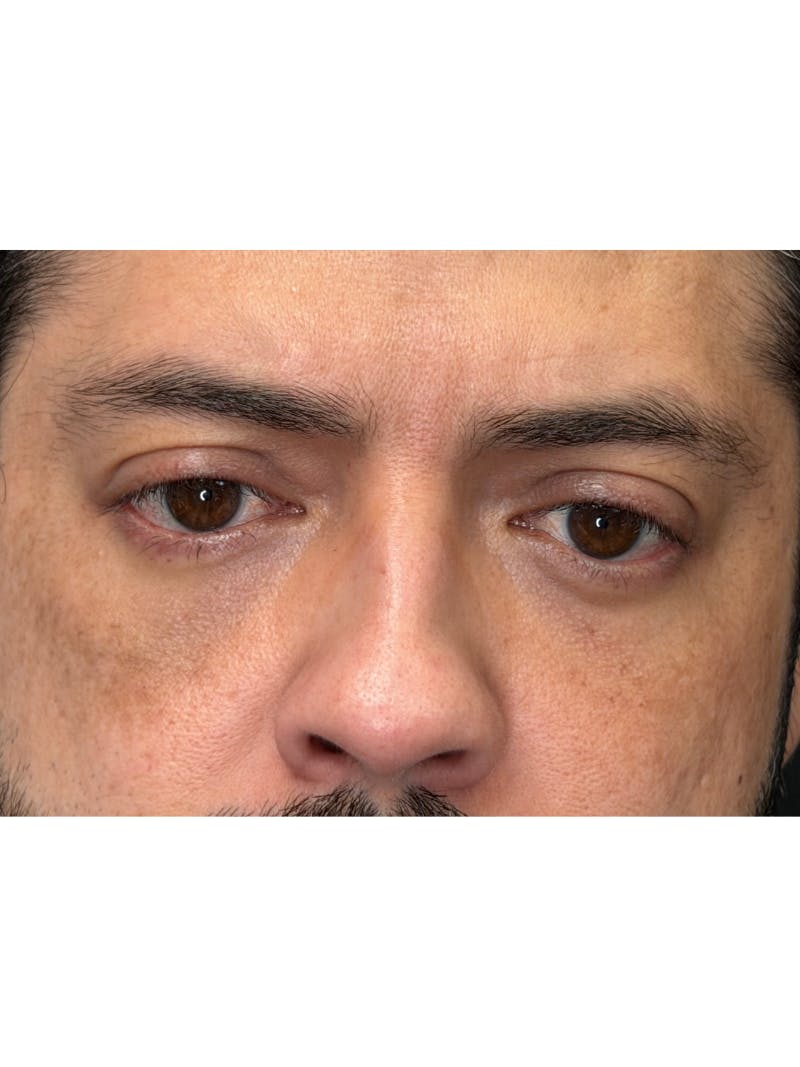 Lower Eye Rejuvenation Before & After Gallery - Patient 201920 - Image 12