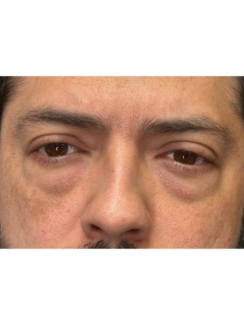 Lower Eye Rejuvenation Before & After Gallery - Patient 201920 - Image 11