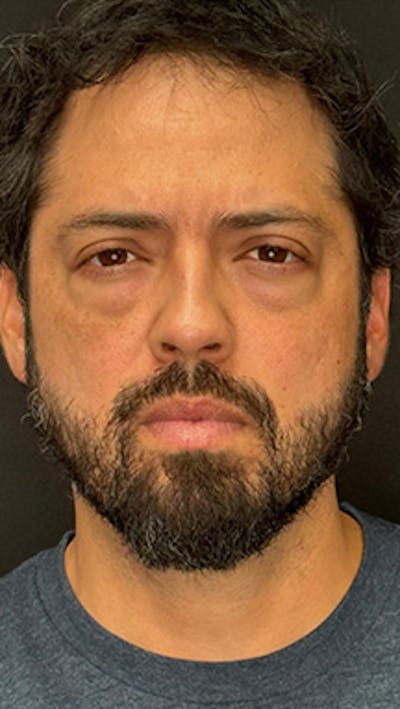 Blepharoplasty LP Before & After Gallery - Patient 370609 - Image 1