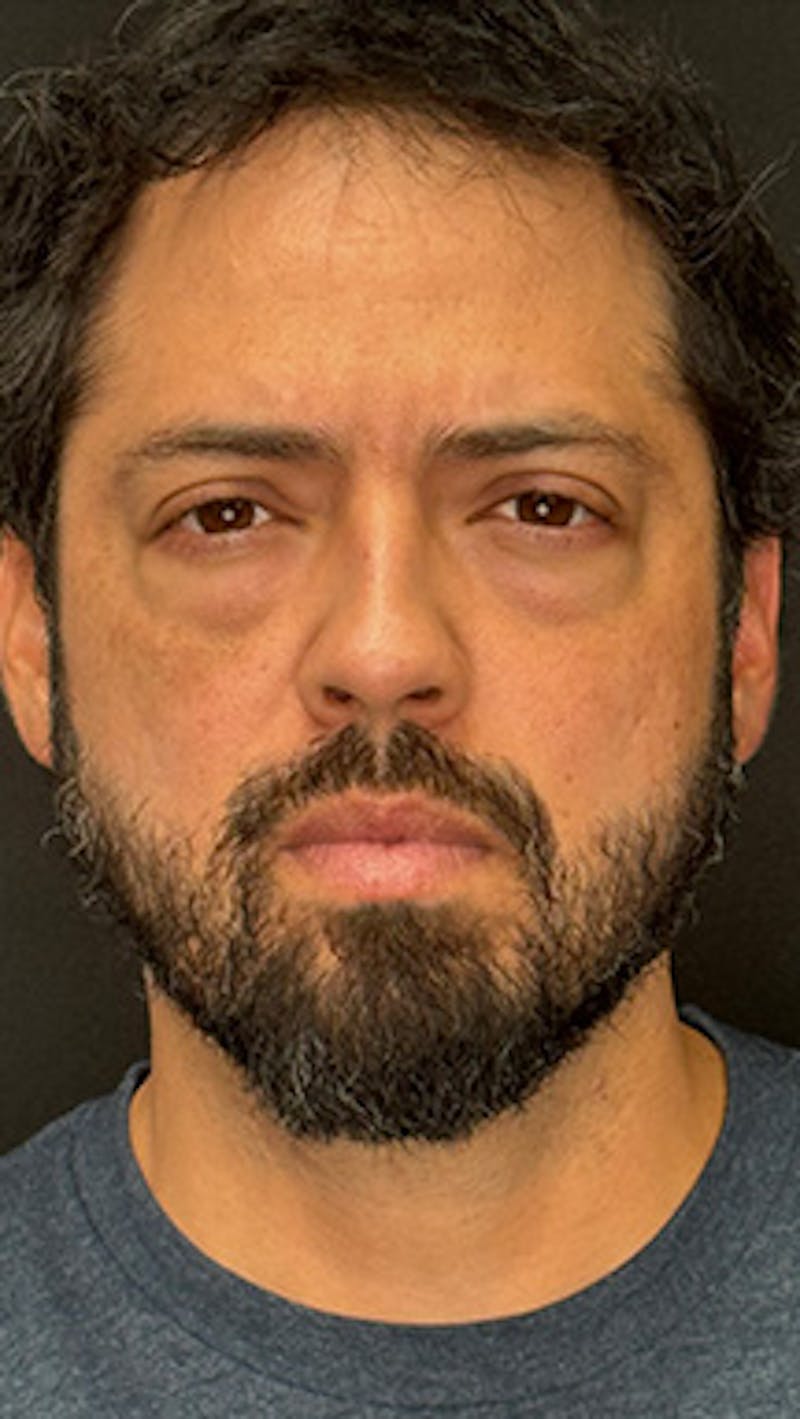 Blepharoplasty LP Before & After Gallery - Patient 370609 - Image 1