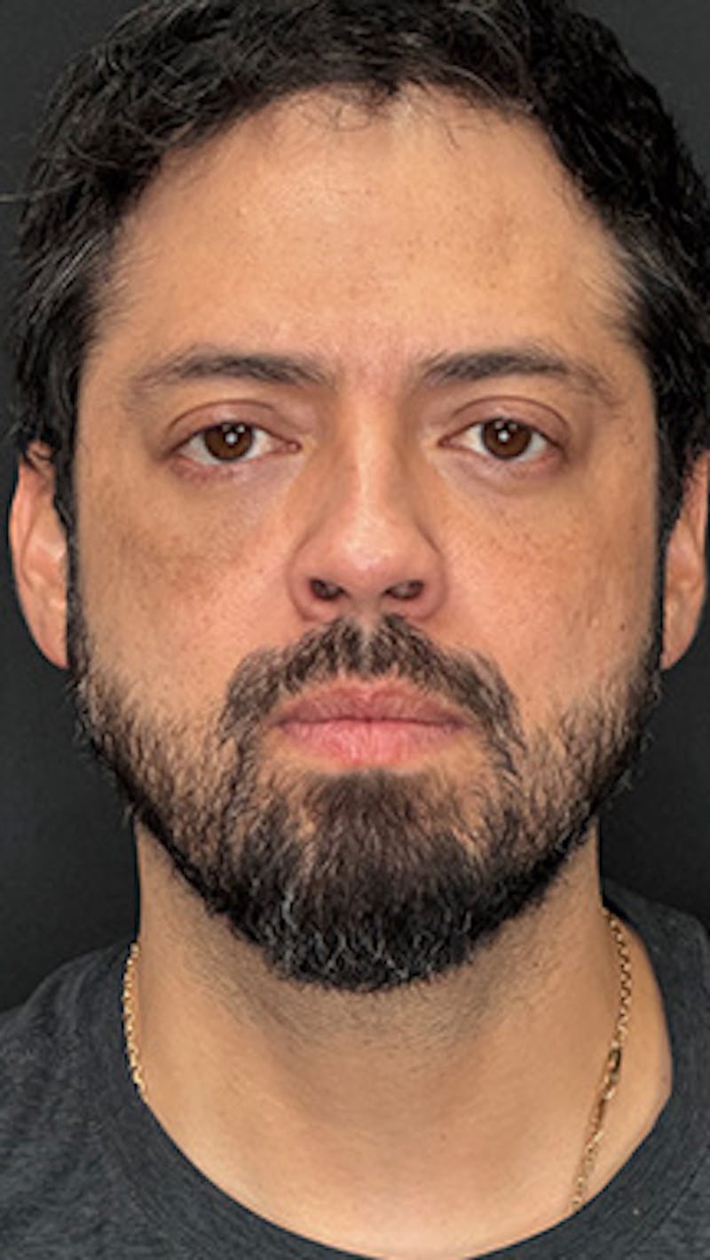 Blepharoplasty LP Before & After Gallery - Patient 370609 - Image 2