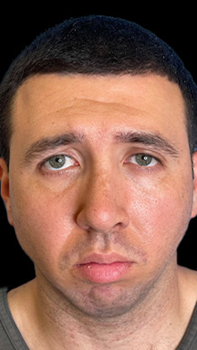 Mandibular Angle Implants Before & After Gallery - Patient 414857 - Image 5